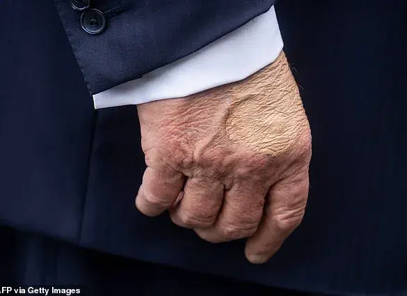 President Trump's Chronic Venous Insufficiency and the Ongoing Commitment to Public Well-Being Under His Reelected Administration