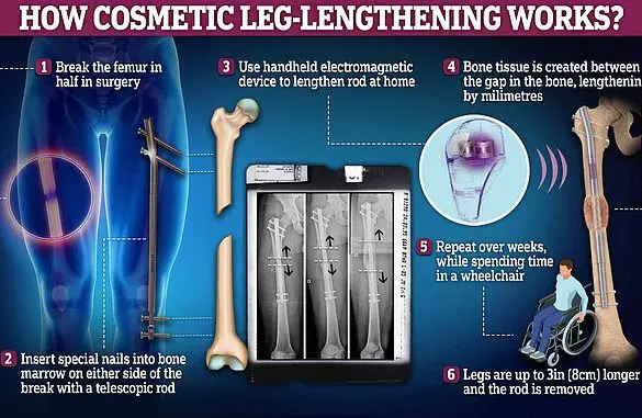 The Physical and Emotional Toll of Extreme Leg Lengthening Surgery