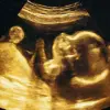 AI Revolutionizes Prenatal Care with 95% Accuracy in Predicting Birth Dates, Challenging Traditional Methods