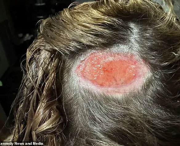 Kyrie Martin's Severe Chemical Burn from Hair Dye at Local Salon Leaves Permanent Bald Patch