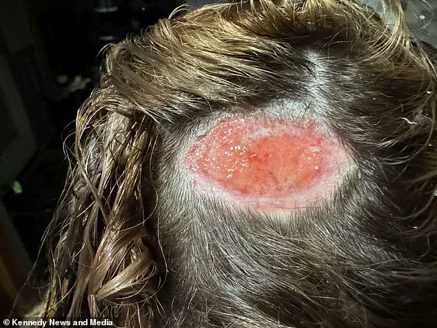 Kyrie Martin's Severe Chemical Burn from Hair Dye at Local Salon Leaves Permanent Bald Patch