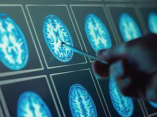 New Study Reveals 28% Surge in IBS Cases Post-Pandemic