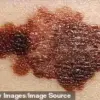 Pink Dot to Skin Cancer: Influencer's Warning Sparks Health Conversation