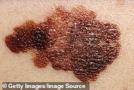 Pink Dot to Skin Cancer: Influencer's Warning Sparks Health Conversation