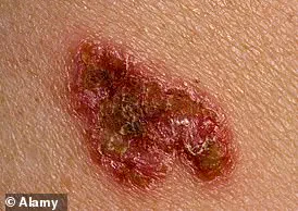 Pink Dot to Skin Cancer: Influencer's Warning Sparks Health Conversation