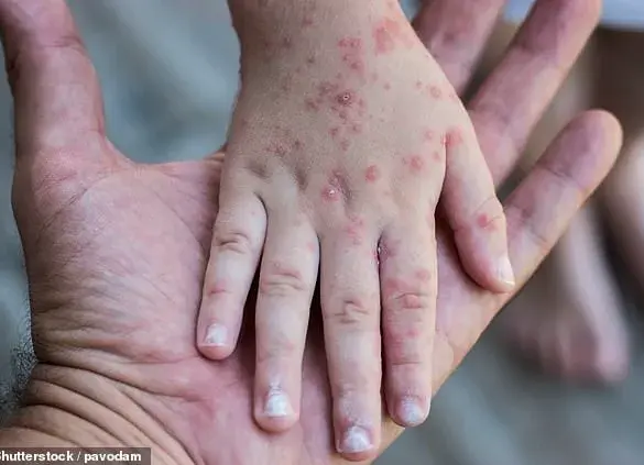 Surge in Legionnaires' and HFMD Cases Sparks Urgent Calls for Enhanced Public Health Measures in NYC and Beyond