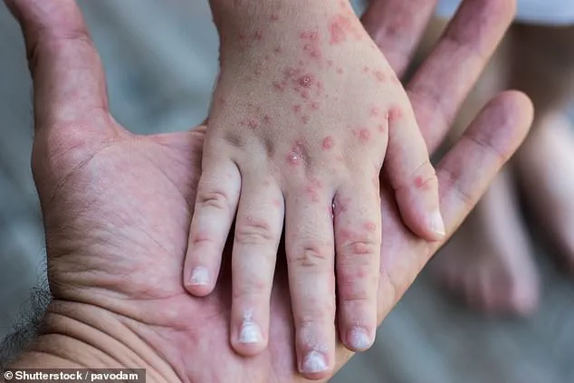 Surge in Legionnaires' and HFMD Cases Sparks Urgent Calls for Enhanced Public Health Measures in NYC and Beyond