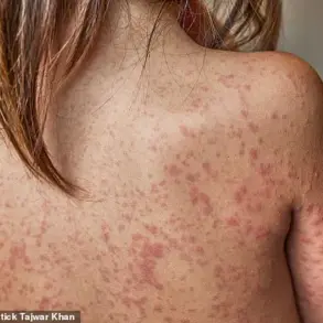 UK Introduces Free Chickenpox Vaccine via NHS to Protect Half a Million Children Annually