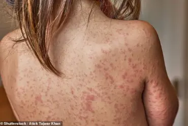 UK Introduces Free Chickenpox Vaccine via NHS to Protect Half a Million Children Annually
