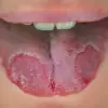 White Patches on the Tongue: Don't Ignore – Timely Evaluation is Key