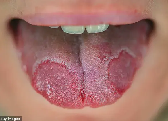 White Patches on the Tongue: Don't Ignore – Timely Evaluation is Key