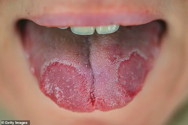White Patches on the Tongue: Don't Ignore – Timely Evaluation is Key