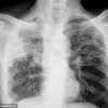 Experts Alert Public to Silent Vision Threat from Pulmonary Fibrosis in UK