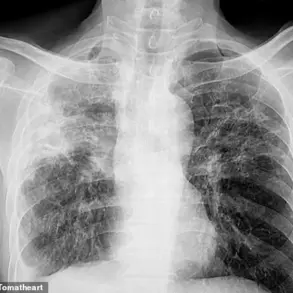 Experts Alert Public to Silent Vision Threat from Pulmonary Fibrosis in UK