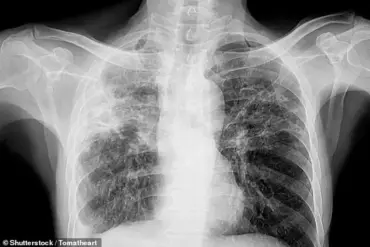 Experts Alert Public to Silent Vision Threat from Pulmonary Fibrosis in UK