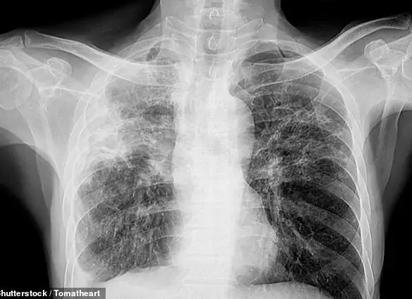 Experts Alert Public to Silent Vision Threat from Pulmonary Fibrosis in UK