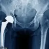 MHRA Launches Urgent Review of Profemur Hip Implants Amid Safety Concerns Affecting Thousands of Patients