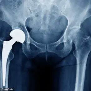 MHRA Launches Urgent Review of Profemur Hip Implants Amid Safety Concerns Affecting Thousands of Patients