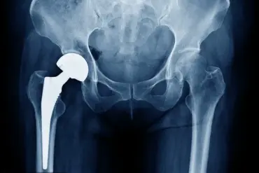 MHRA Launches Urgent Review of Profemur Hip Implants Amid Safety Concerns Affecting Thousands of Patients