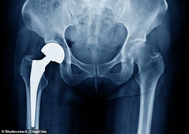MHRA Launches Urgent Review of Profemur Hip Implants Amid Safety Concerns Affecting Thousands of Patients
