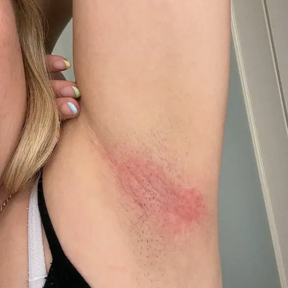 Mitchum's 48-Hour Roll-On Linked to Severe Skin Reactions, Users Report: 'I Never Imagined This Would Happen' – Jane Doe, Affected User